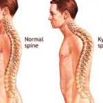 حرکات اصلاحی برای افتادگی شانه ها