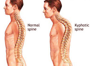 حرکات اصلاحی برای افتادگی شانه ها