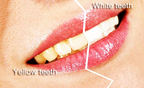  راه های از بین بردن زردی دندان, از بین بردن زردی دندان ها, روش های از بین بردن زردی دندان