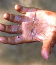 بیماری جذام چیست