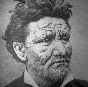 بیماری جذام چیست