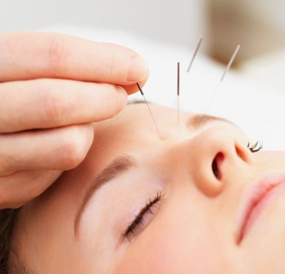 فواید طب سوزنی چیست,اثرات طب سوزنی,فایده طب سوزنی,فواید طب سوزنی